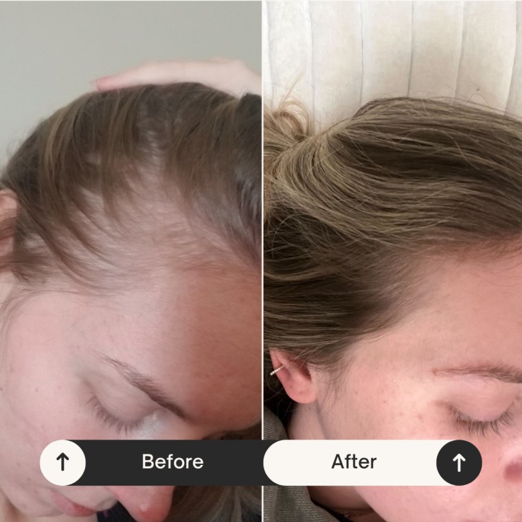 Woman showing hair growth before and after.