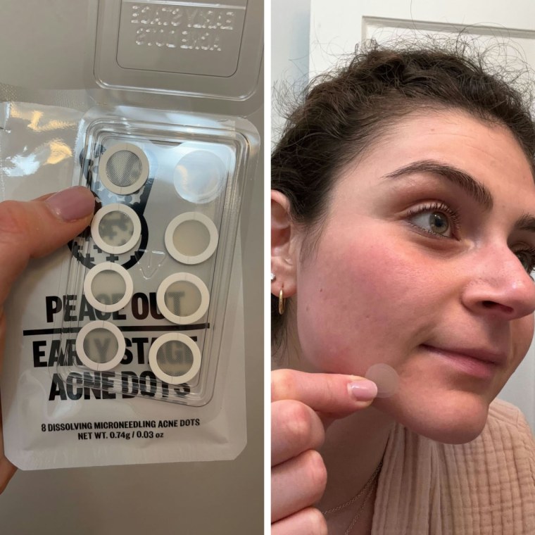 NBC Select Associate Updates Editor Zoe Malin uses Peace Out's Early Stage Acne Dots to treat her breakouts.