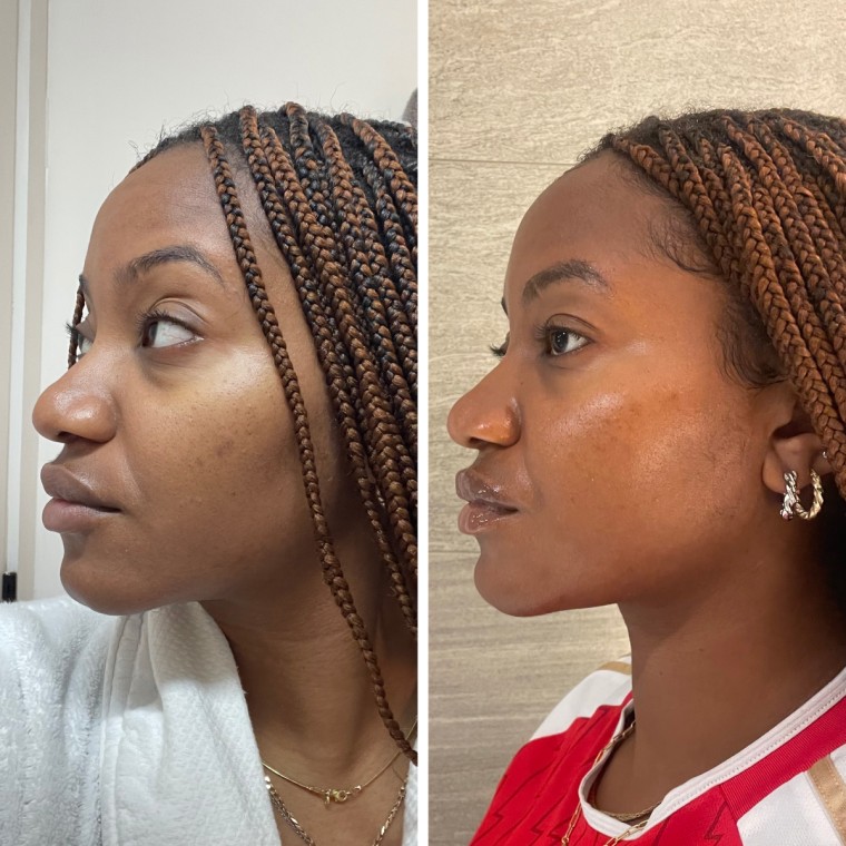 On the left, a woman displays acne scars on her left cheek. The scars appear two to three shades darker than her natural darker complexion. On the right, an image of the same acne scars appear eight weeks later; this time, they are lighter and blend more into her skin tone.